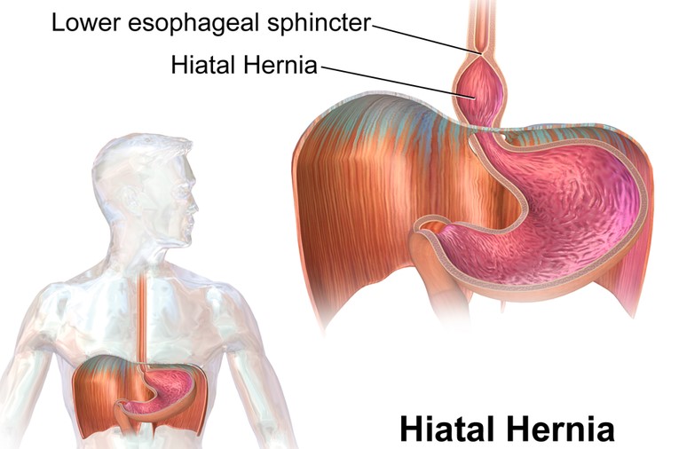 Hiatal Hernia Symptoms Causes And Treatment Live Tech Spot
