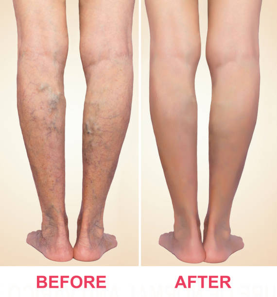 Varicose Veins Treatment Cost in Abu Dhabi