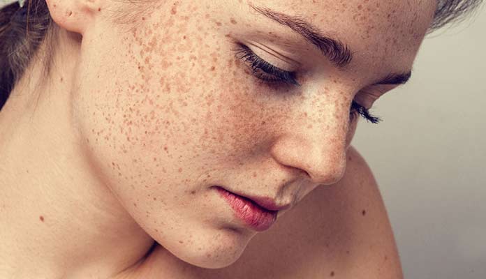 Melasma Treatment
