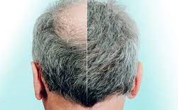 زراعة الشعر