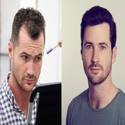 Hair Transplant in dubai