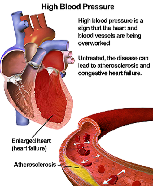 high blood pressure