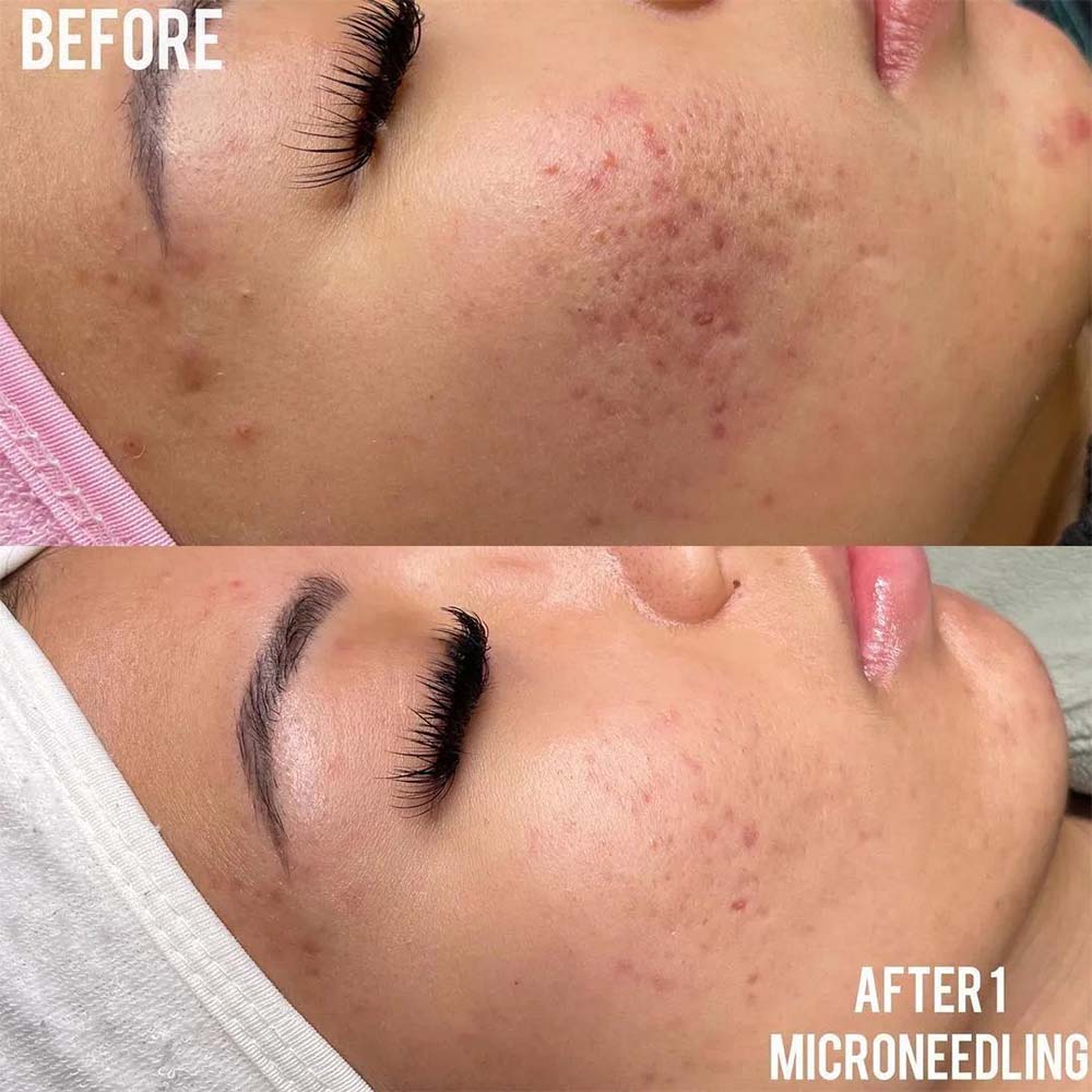 pigmentation treatment warrenton va