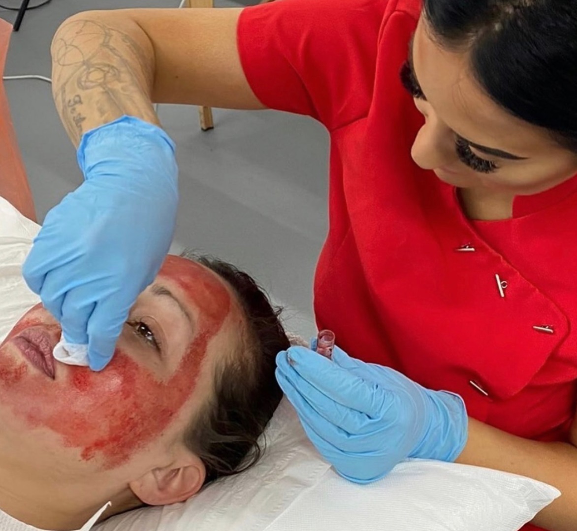 prp treatment for face
