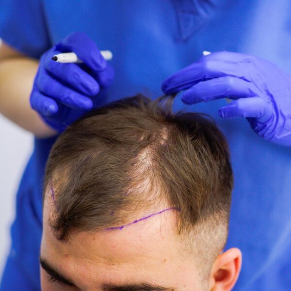 Hair transplant cost