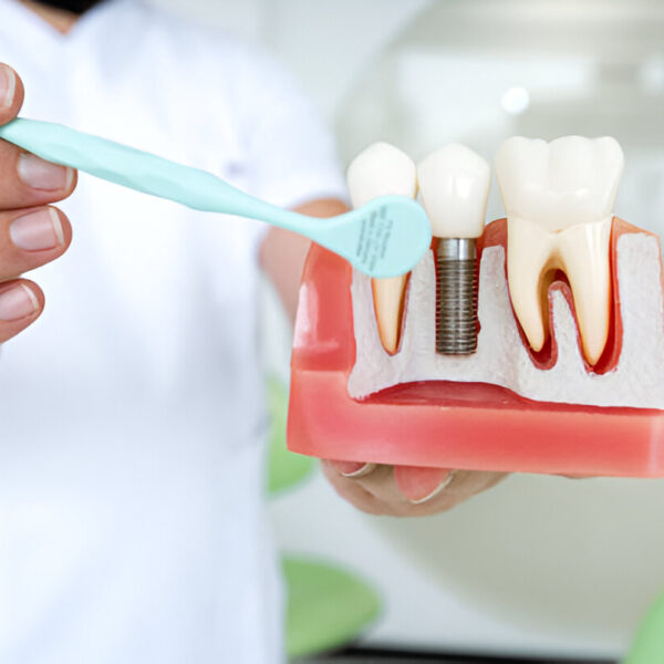 Trusted Dental Implant Solutions at Loves Park Family Dental at IL