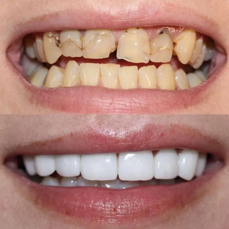 Best Dental Veneers in Dubai Veneers That Make You Shine